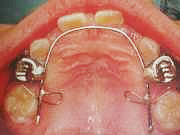舌側矯正装置